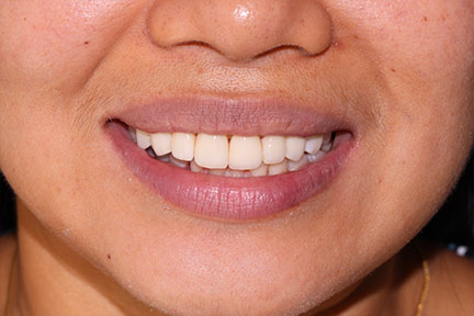 zirconia-veneers-bna3-after