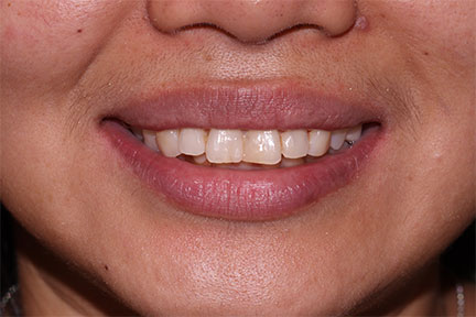 zirconia-veneers-bna3-before