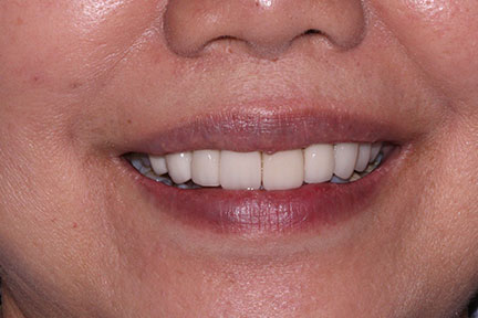 zirconia-veneers-bna4-after