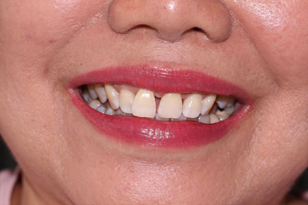 zirconia-veneers-bna4-before