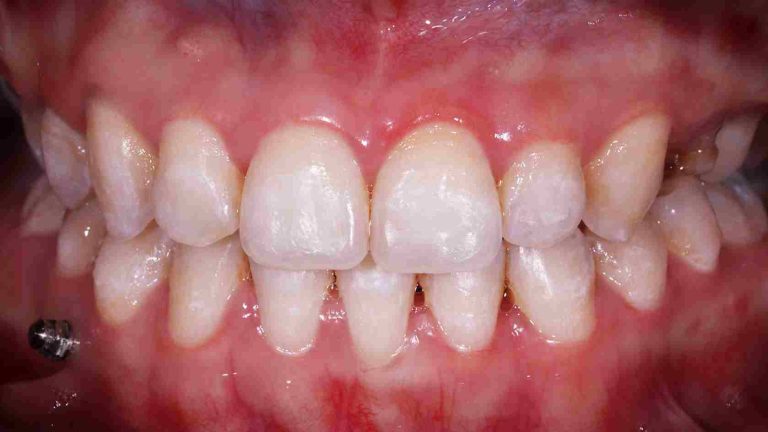 Service-Teeth-Whitening-BnA-Before_11zon