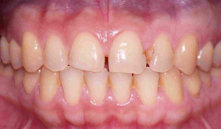 Service-Veneers-BnA-Before_11zon