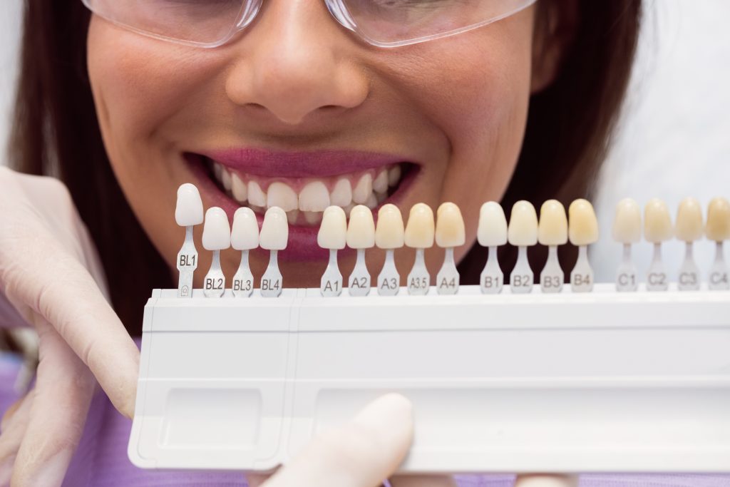 things to consider before a dental veneer treatment