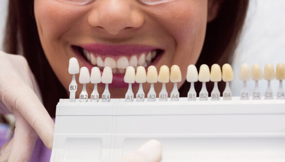 Things To Consider Before A Veneer Treatment