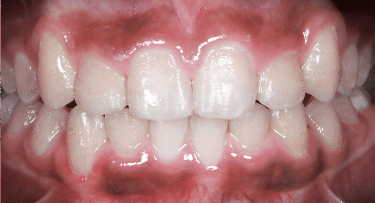 Braces_Akshaj Sharman_After