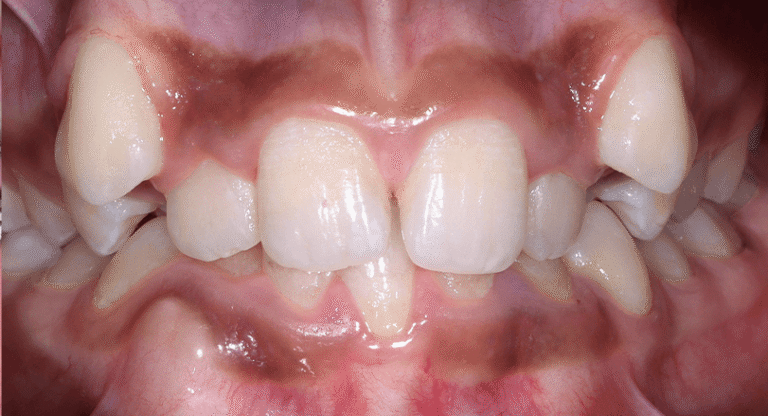 Braces_Akshaj Sharman_Before