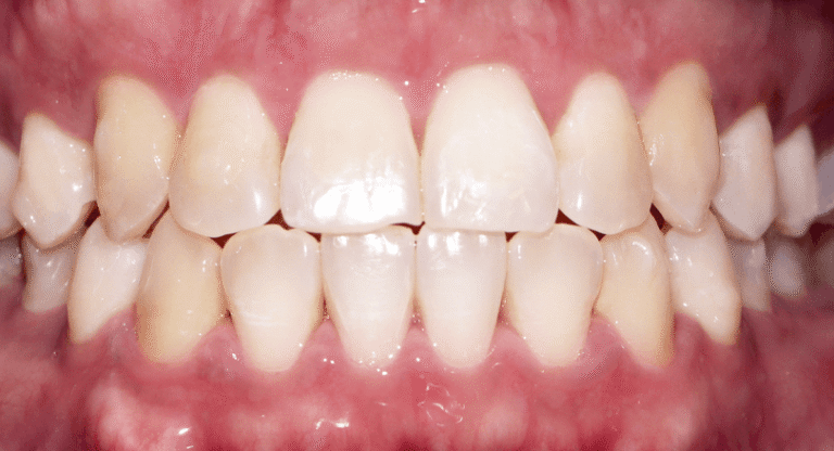 Invisalign - BnA 4 - Marion Adalia_After