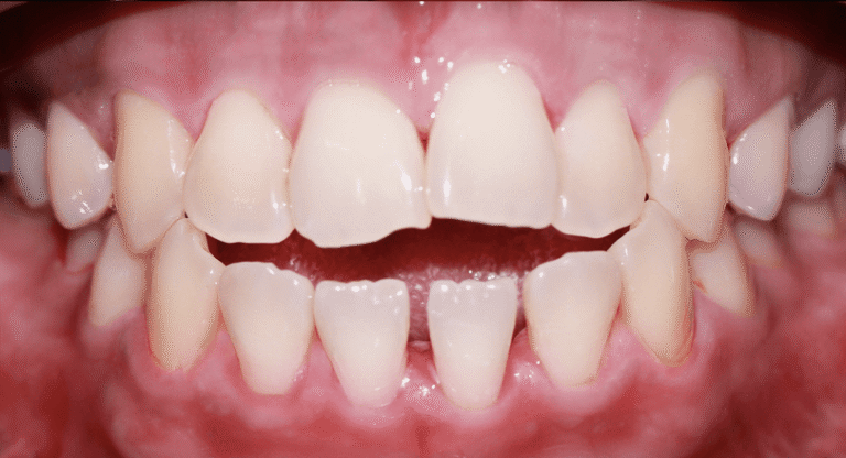 Invisalign - BnA 4 - Marion Adalia_Before