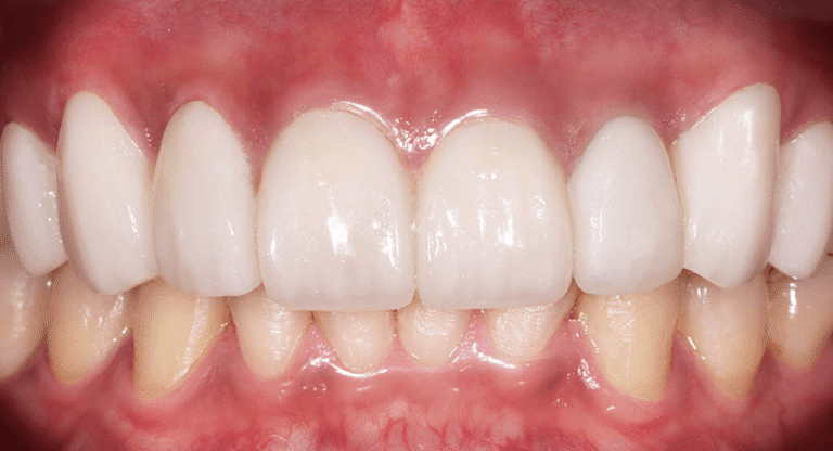 Porcelain - BnA 2 - Discolored Teeth, Old Restoration - Kenneth Viterbo_After
