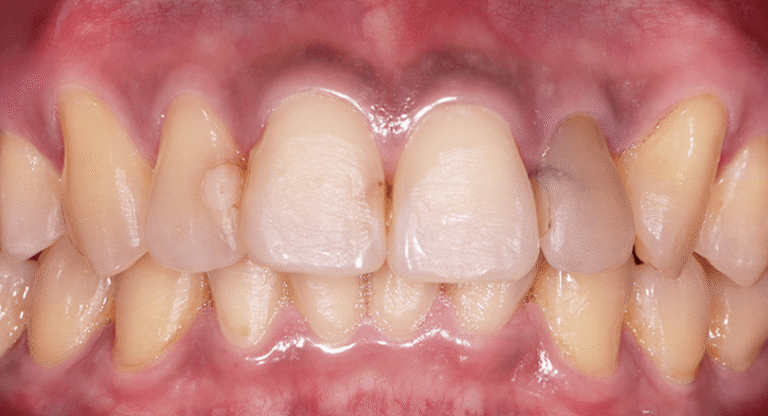Porcelain - BnA 2 - Discolored Teeth, Old Restoration - Kenneth Viterbo_Before