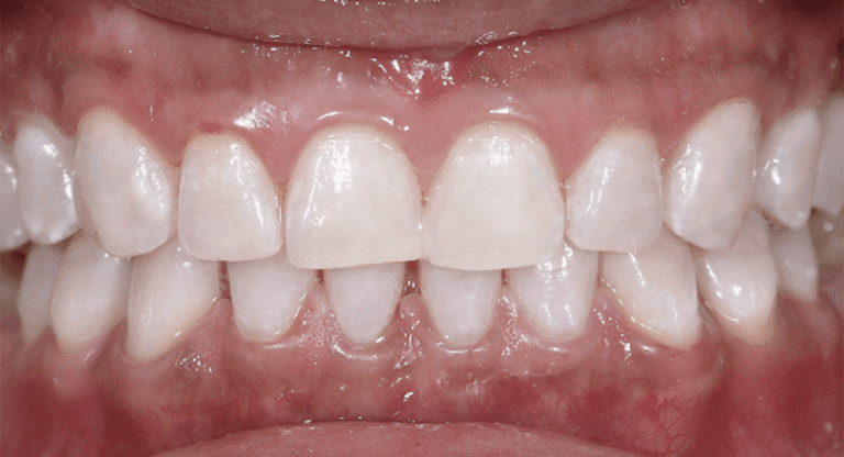 Teeth Whitening - BnA 6 - Kaith Torres_After