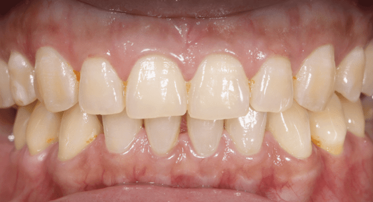 Teeth Whitening - BnA 6 - Kaith Torres_Before